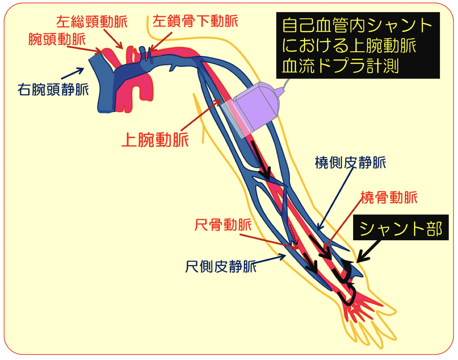 シャントエコー(VAエコー)とは|血流量・評価項目・見かたをわかりやすく解説 | ceme.me