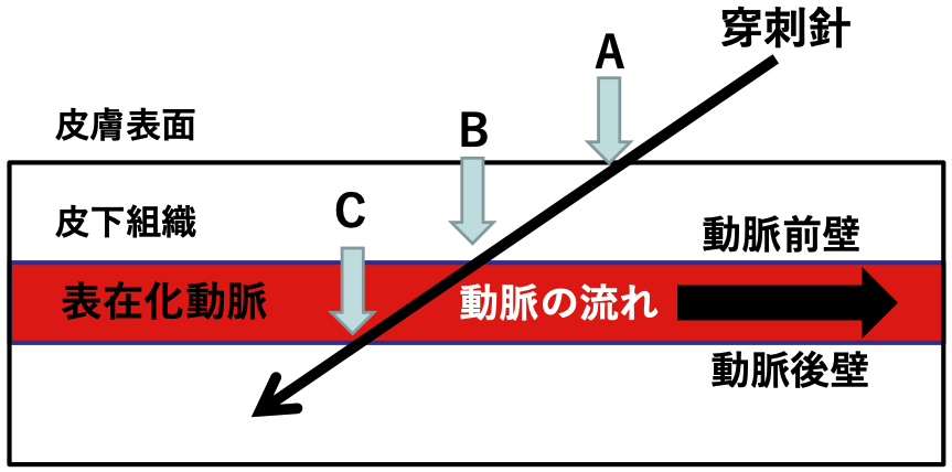 透析シャントにおける動脈表在化 | me