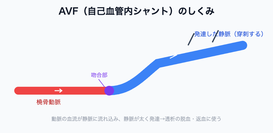AVF（自己血管内シャント）のしくみ（動脈と静脈を吻合し静脈を発達させる）