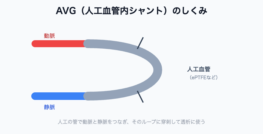 AVG(人工血管内シャント)のしくみ(人工血管で動脈と静脈をつなぐ)