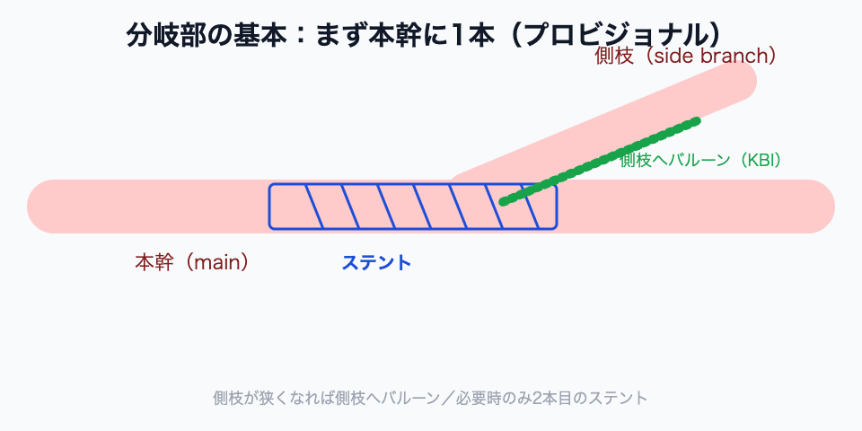 分岐部ステントの基本（本幹に1本＋必要なら側枝へバルーン）