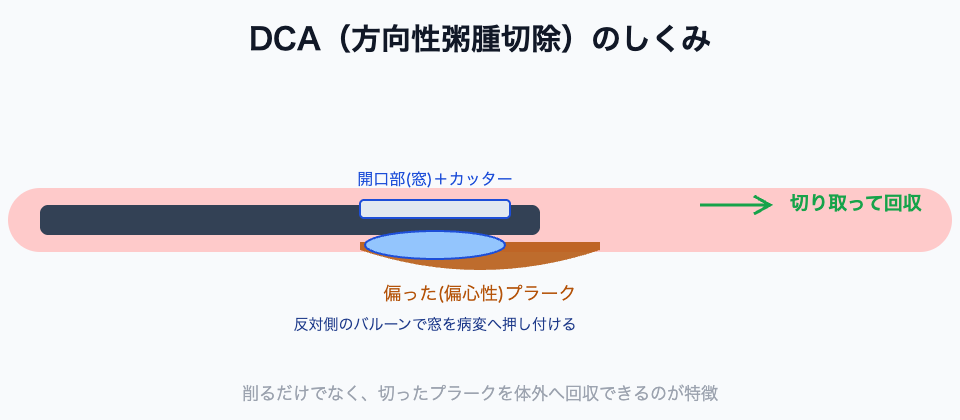 DCAのしくみ(偏心性プラークを方向を決めて切除・回収)
