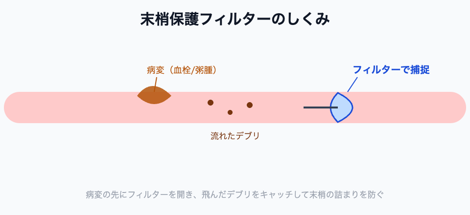 末梢保護フィルターのしくみ（病変の先でデブリを捕捉）
