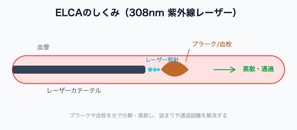 ELCAのしくみ(308nmレーザーでプラーク・血栓を蒸散)