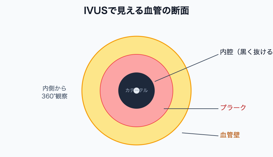 IVUSで見える血管の断面（内腔・プラーク・血管壁）