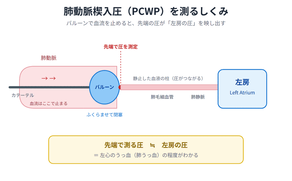 肺動脈楔入圧PCWPを測るしくみ:バルーンで血流を止めると先端の圧が左房圧を反映する