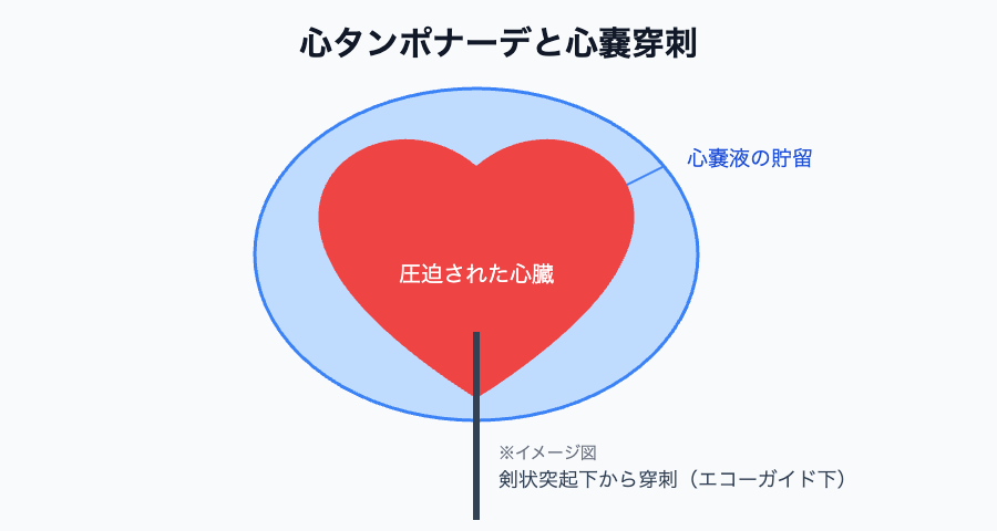 心タンポナーデと心嚢穿刺のイメージ（剣状突起下からエコーガイド下に穿刺）