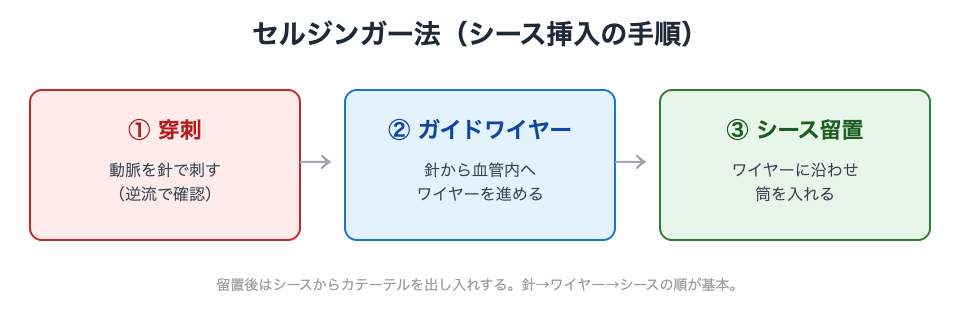 セルジンガー法：穿刺→ガイドワイヤー→シース留置