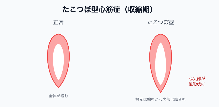 たこつぼ型心筋症（心尖部が風船状にバルーニング）