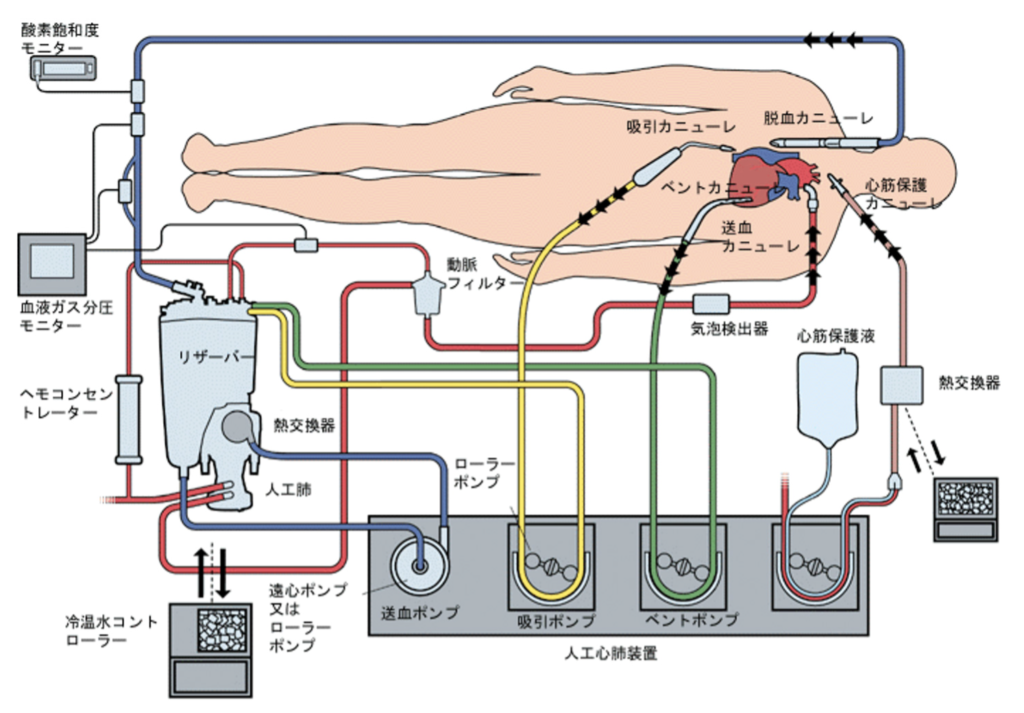開心術で用いる人工心肺の回路図。脱血カニューレ、吸引カニューレ、酸素飽和度モニターの配置