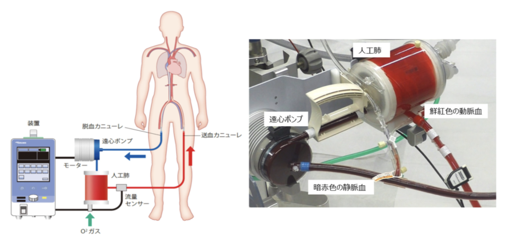 ECMO（PCPS）の回路図と実物写真。脱血カニューレ、遠心ポンプ、人工肺、送血カニューレの位置関係
